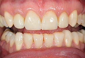 Lincoln Veneers