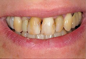 Lincoln Teeth Whitening